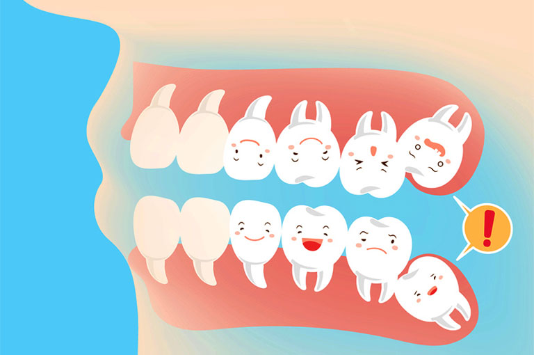 Mọc 2, 4 răng khôn cùng lúc thì như thế nào?